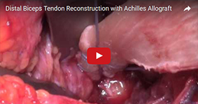 Distal Biceps Tendon Reconstruction with Achilles Allograft