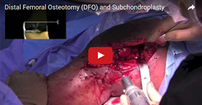 Distal Femoral Osteotomy (DFO) and Subchondroplasty