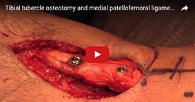 Tibial Osteotomy and Medial Patellofemoral Ligament Reconstruction