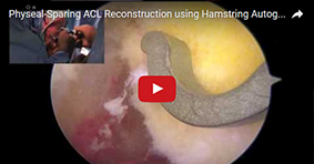 Physeal-Sparing ACL Reconstruction using Hamstring Autograft