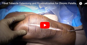 Tibial Tubercle Osteotomy and Proximalization for Chronic Patella Baja