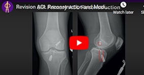 Revision ACL Reconstruction and Modified Lemaire ALL Reconstruction for Recurrent Instability