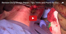 Revision Distal Biceps Repair – Tips Tricks and Pearls for Successful Outcomes